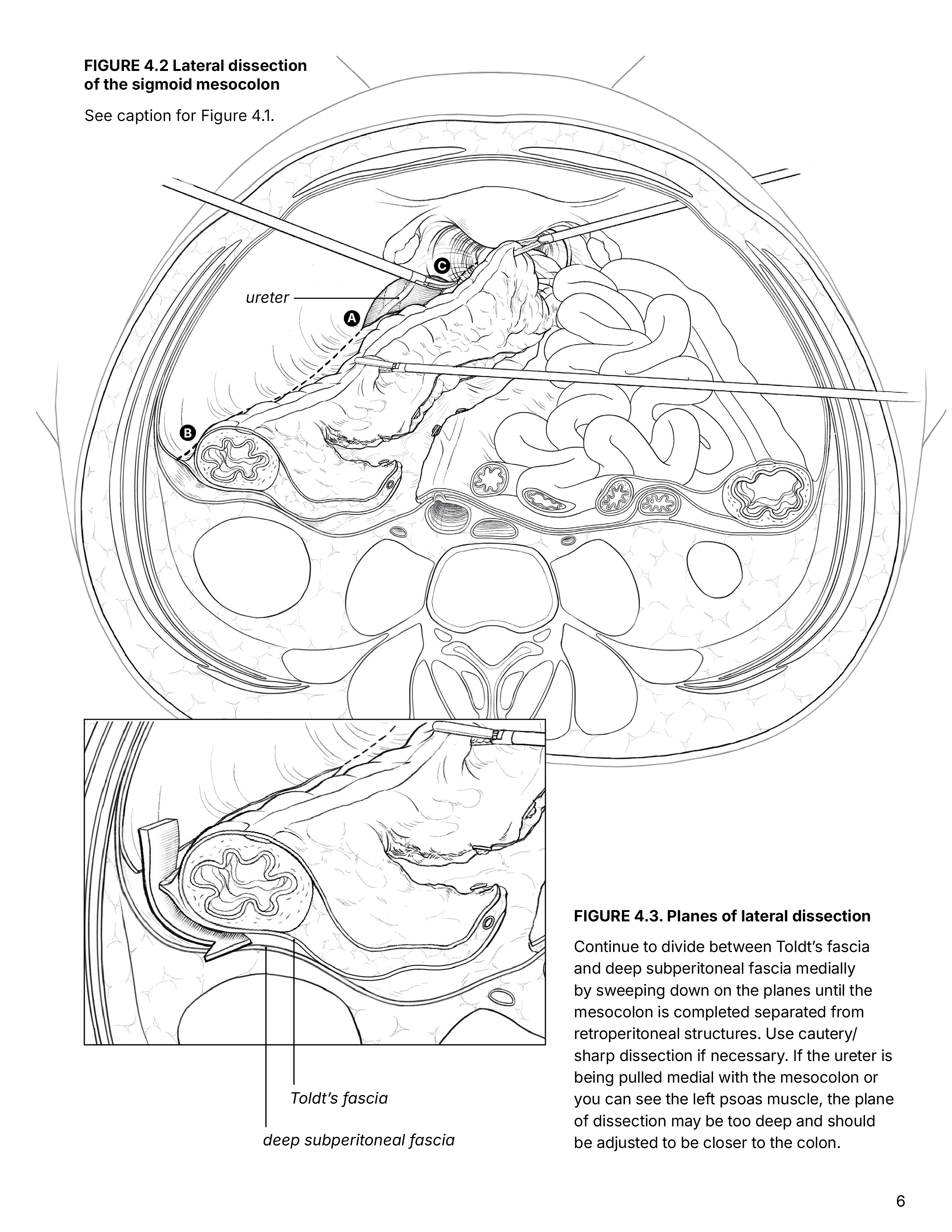 surgical illustration of sigmoidectomy, lateral dissection