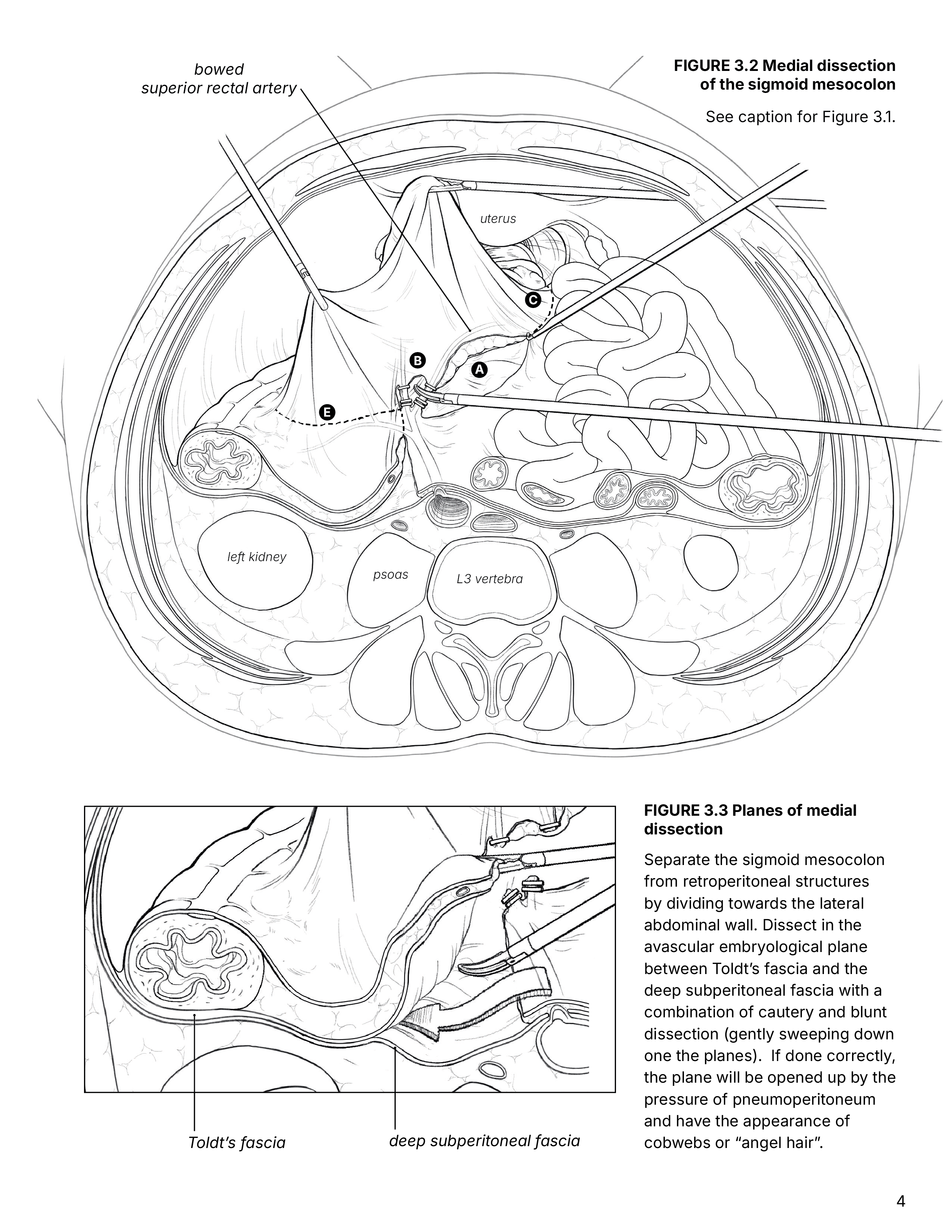 surgical illustration of sigmoidectomy, medial dissection
