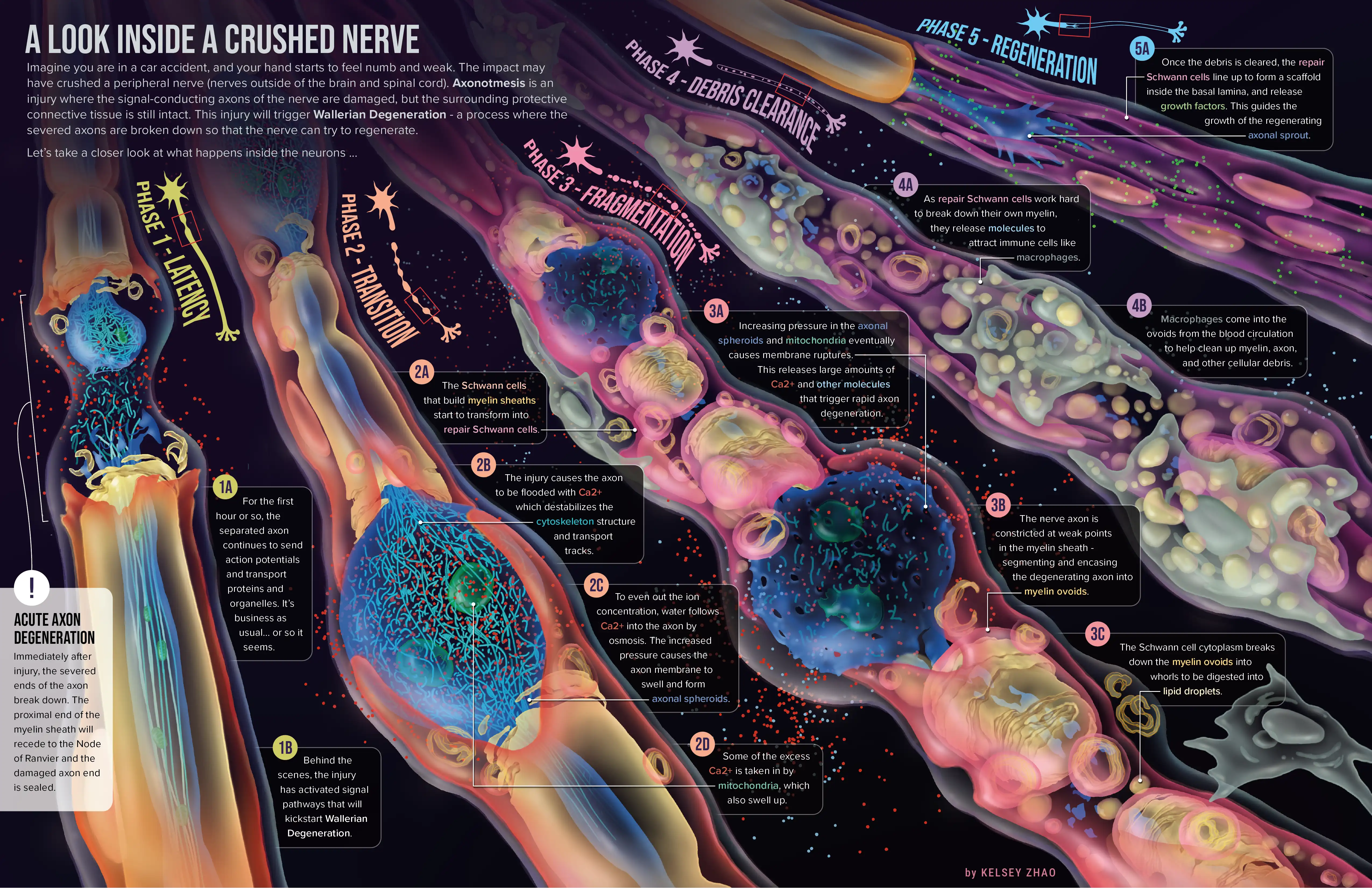Wallerian Degeneration Infographic