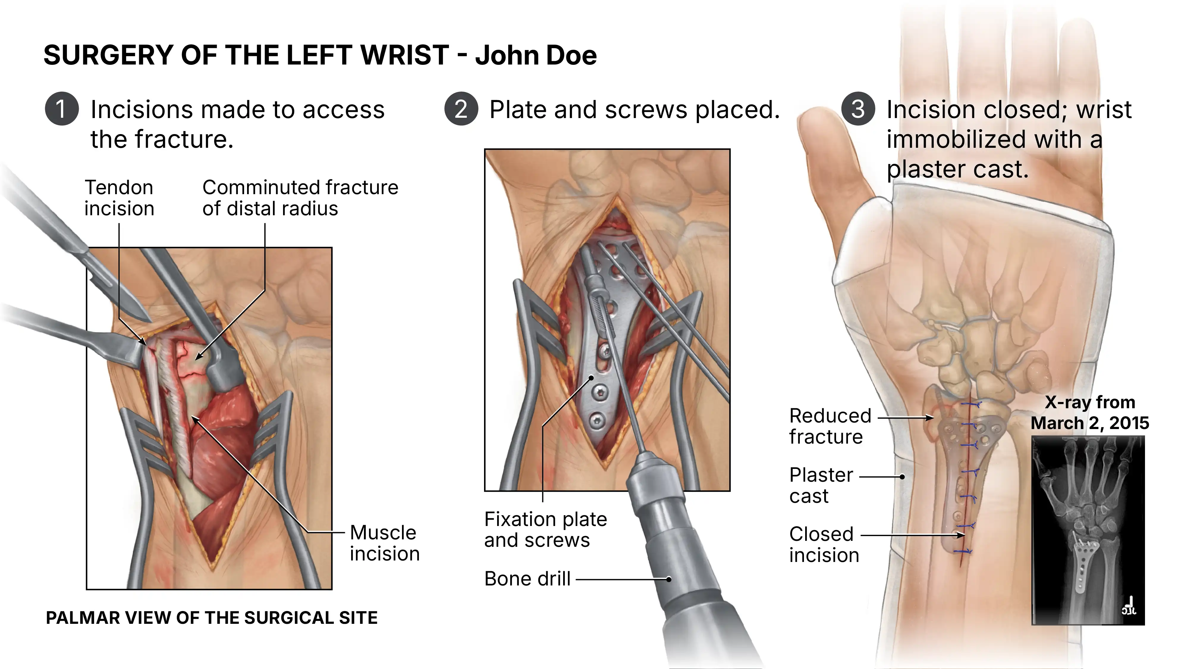 Surgery of the Left Wrist